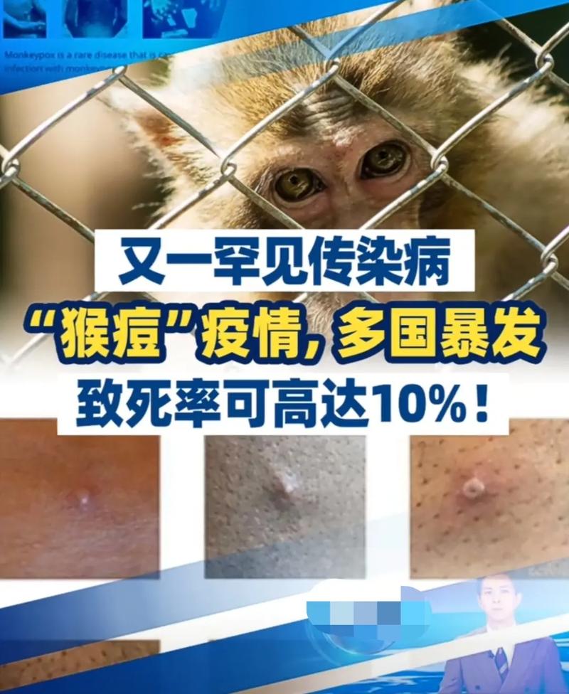 猴痘已经波及12国，致死率高达10%，40岁以下人群无免疫力，美国已采购数百万剂疫苗，我们应该担心吗猴痘病毒的传播途径欧美多国突发“猴痘”疫情，到底多严重 型号(167038)